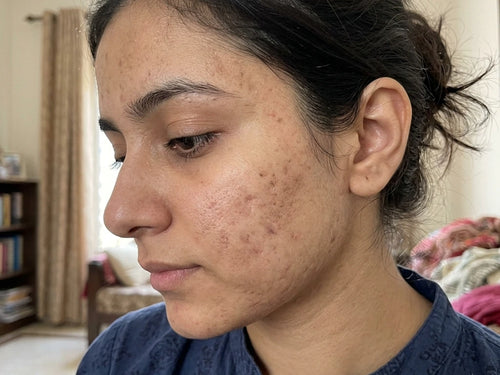 Before — Ayesha