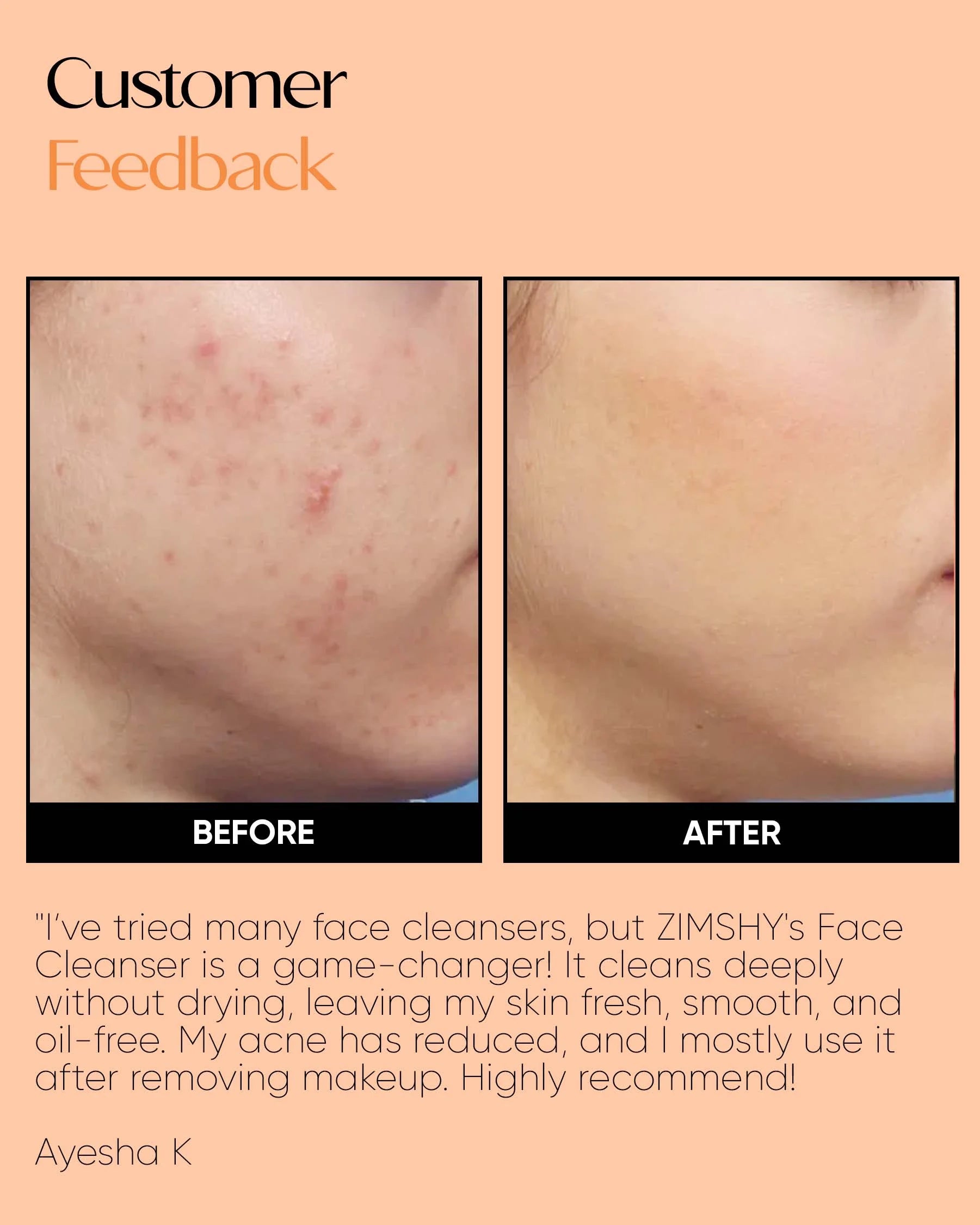 ZIMSHY Face Cleanser with Salicylic Acid, Oil Control Acne Defense for Oily Combination Acne Prone Skin 140ML